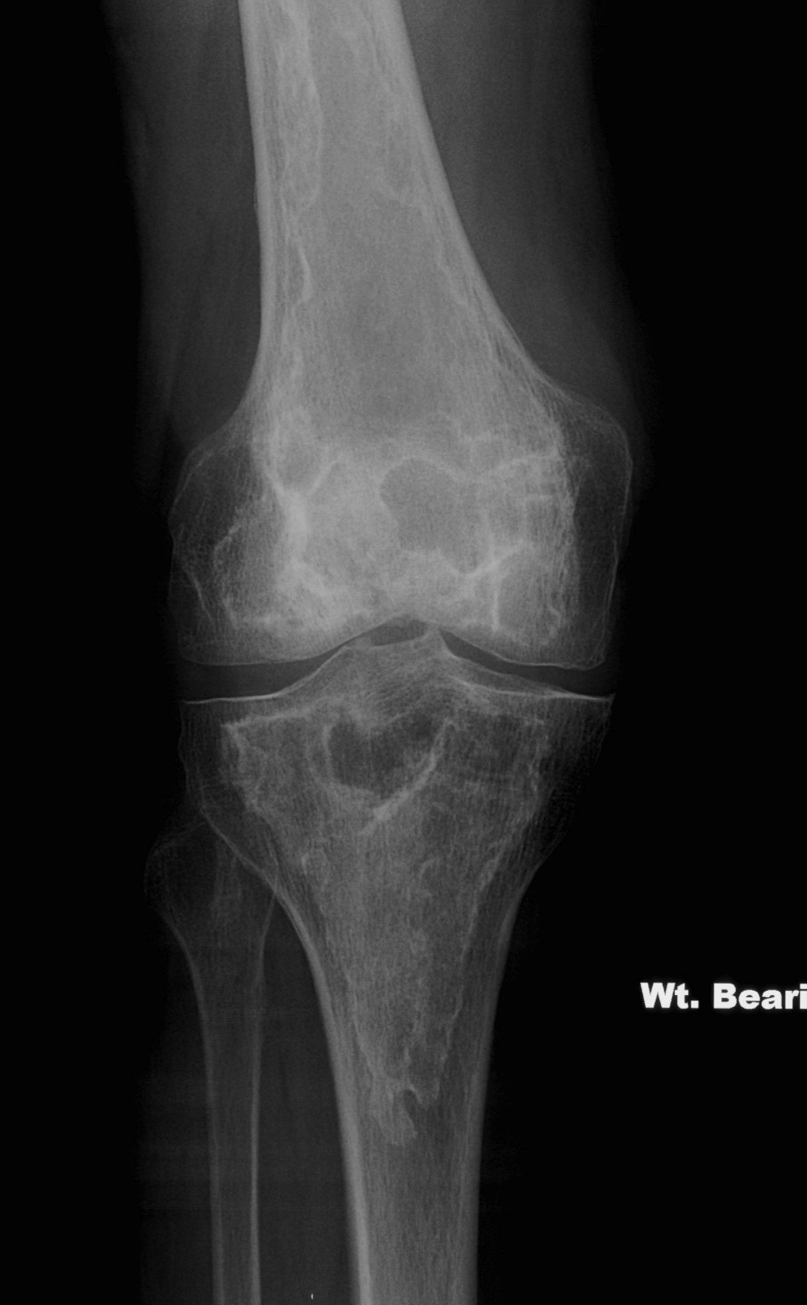 Bone infarct knee