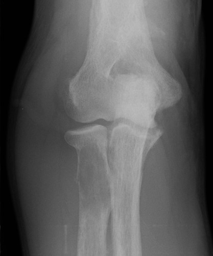 Brown tumour proximal radius