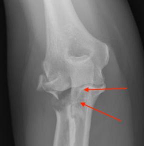 Lesser sigmoid notch