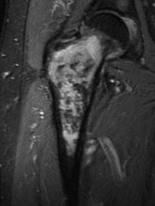 CS mRI hip 1