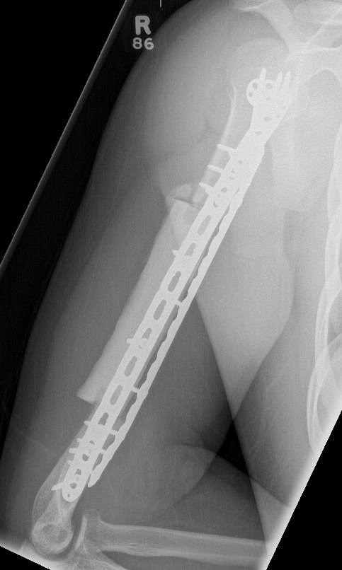 CS Humerus surgery 2