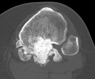 Parosteal tibia CT