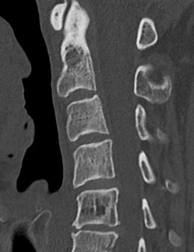 CT hemangioma spine