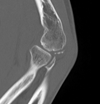 Capitellar OCD CT