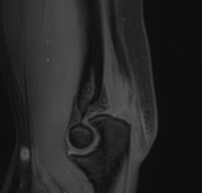 MRI triceps avulsion 4