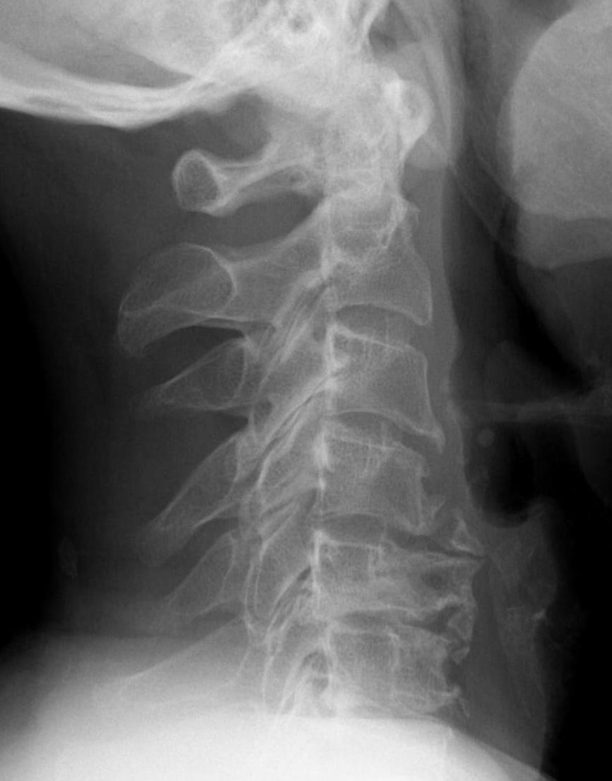 Spondylosis Xray