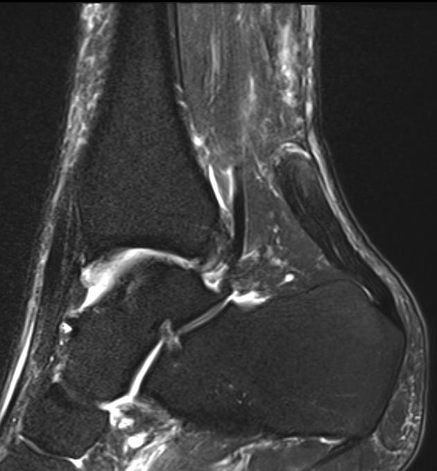 Chronic retracted achilles