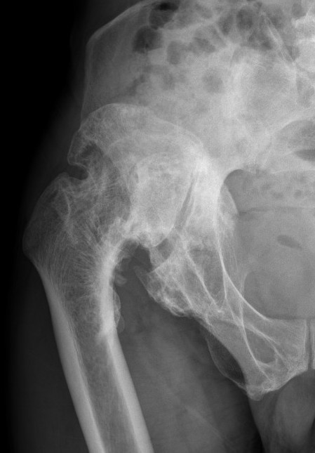 Hip OA trauma