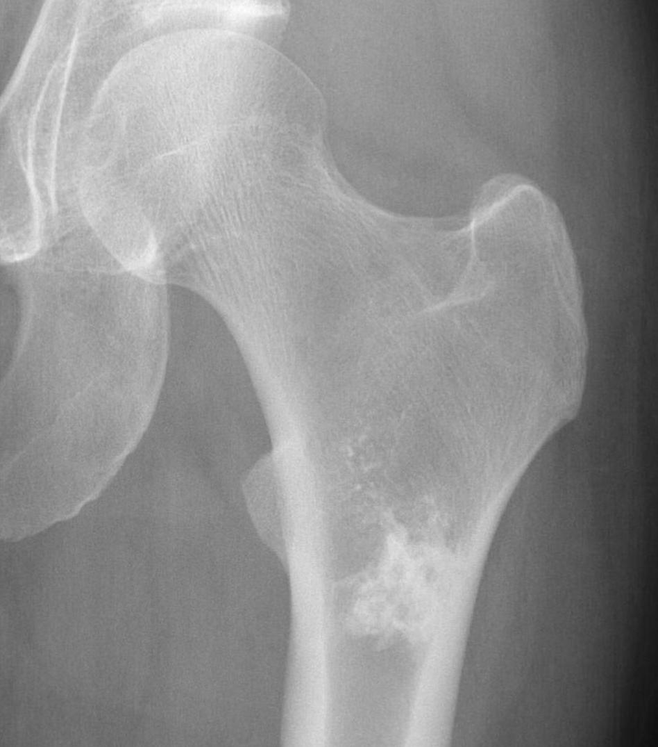 Hip enchondroma