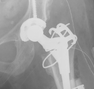 Troch osteotomy