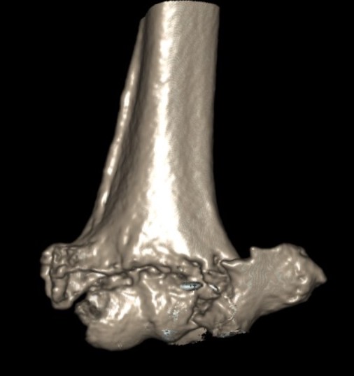 Elderly distal humerus 2