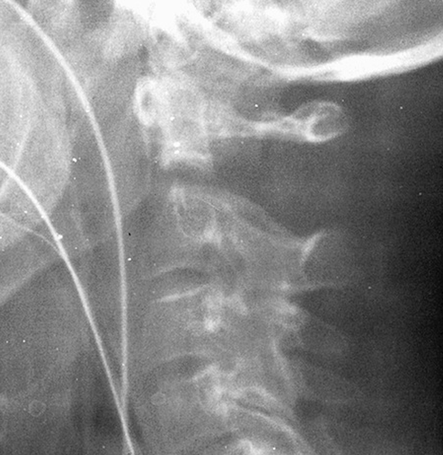 Dens nonunion xray