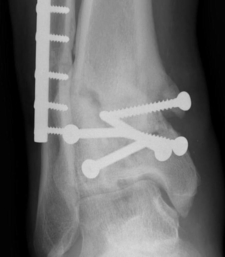 Tibial plafond OA