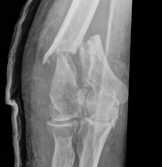 Distal humerus