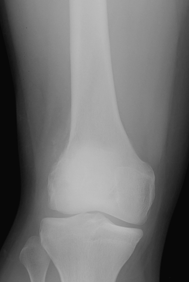 Ewings distal femur