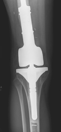 Ewings femur resection 1