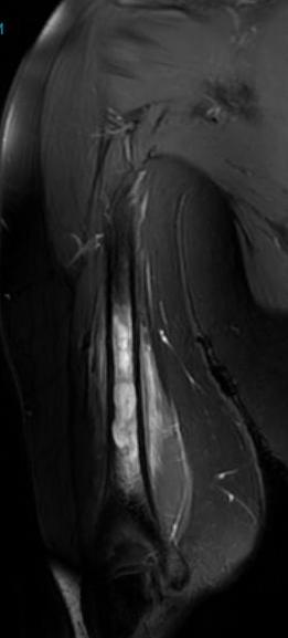 Ewings humerus MRI