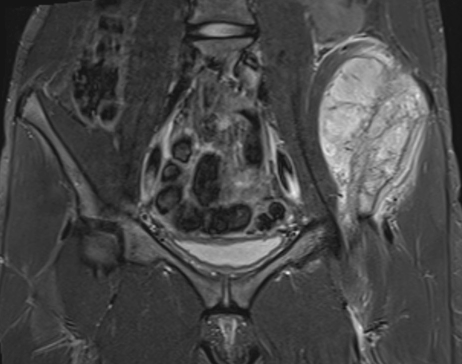 Ewings pelvis MRI