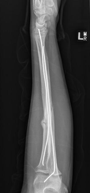 Forearm TENS nonunion 2