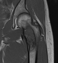 FD hip MRI 2