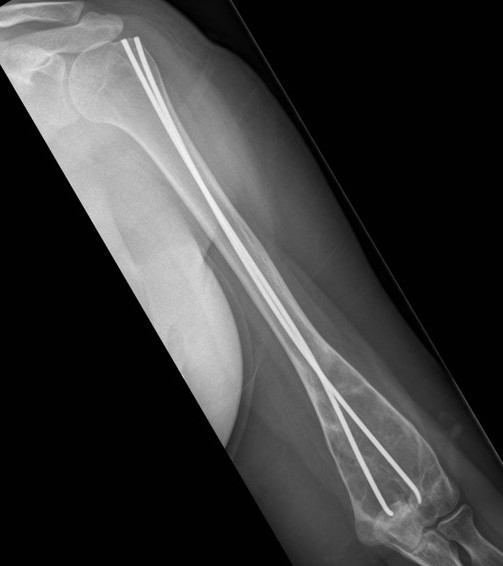 FD Humerus 2