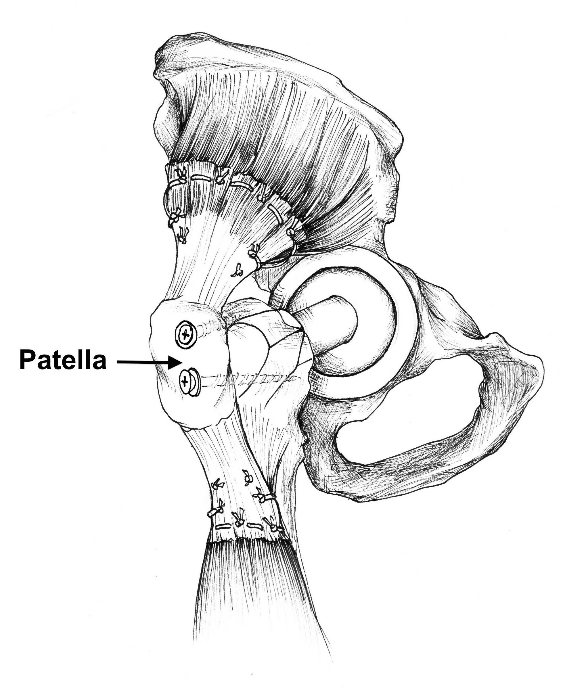 Patella tendon allograft