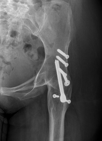 Hip arthrodesis