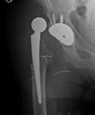 GT fracture dislocation