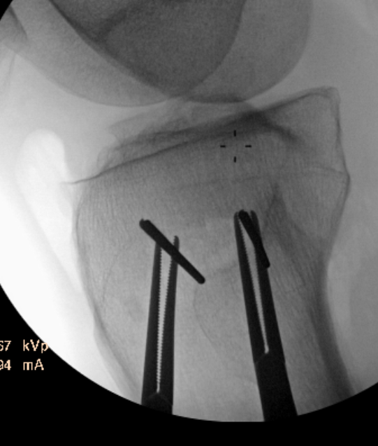 Posterior slope