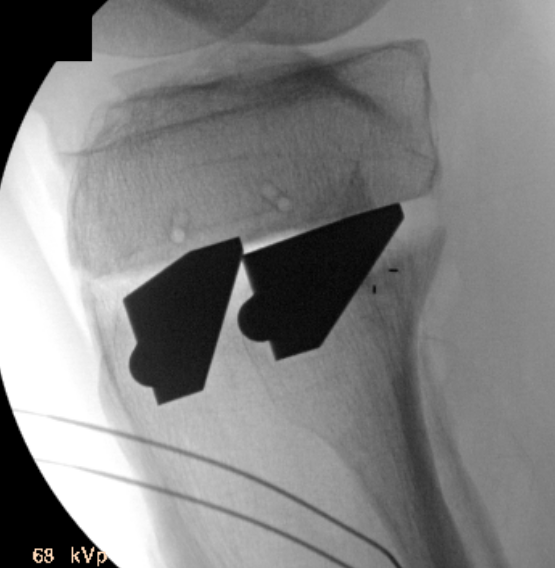 HTO osteotomy