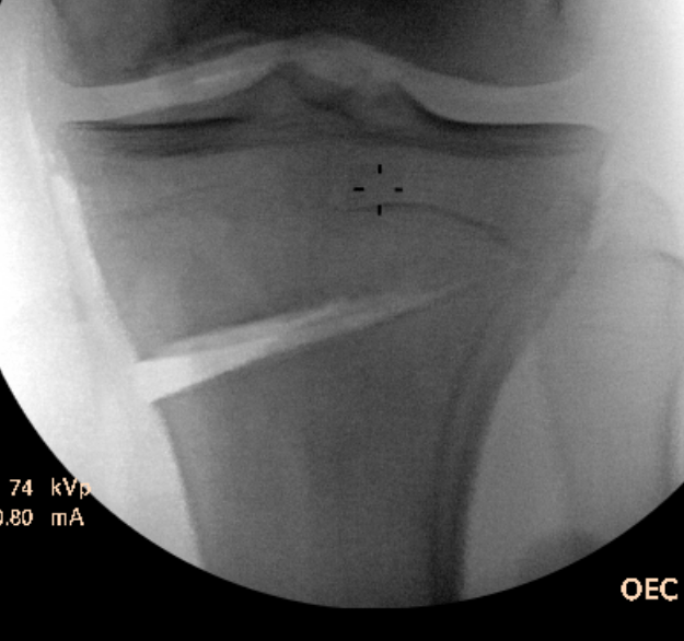 HTO osteotomy