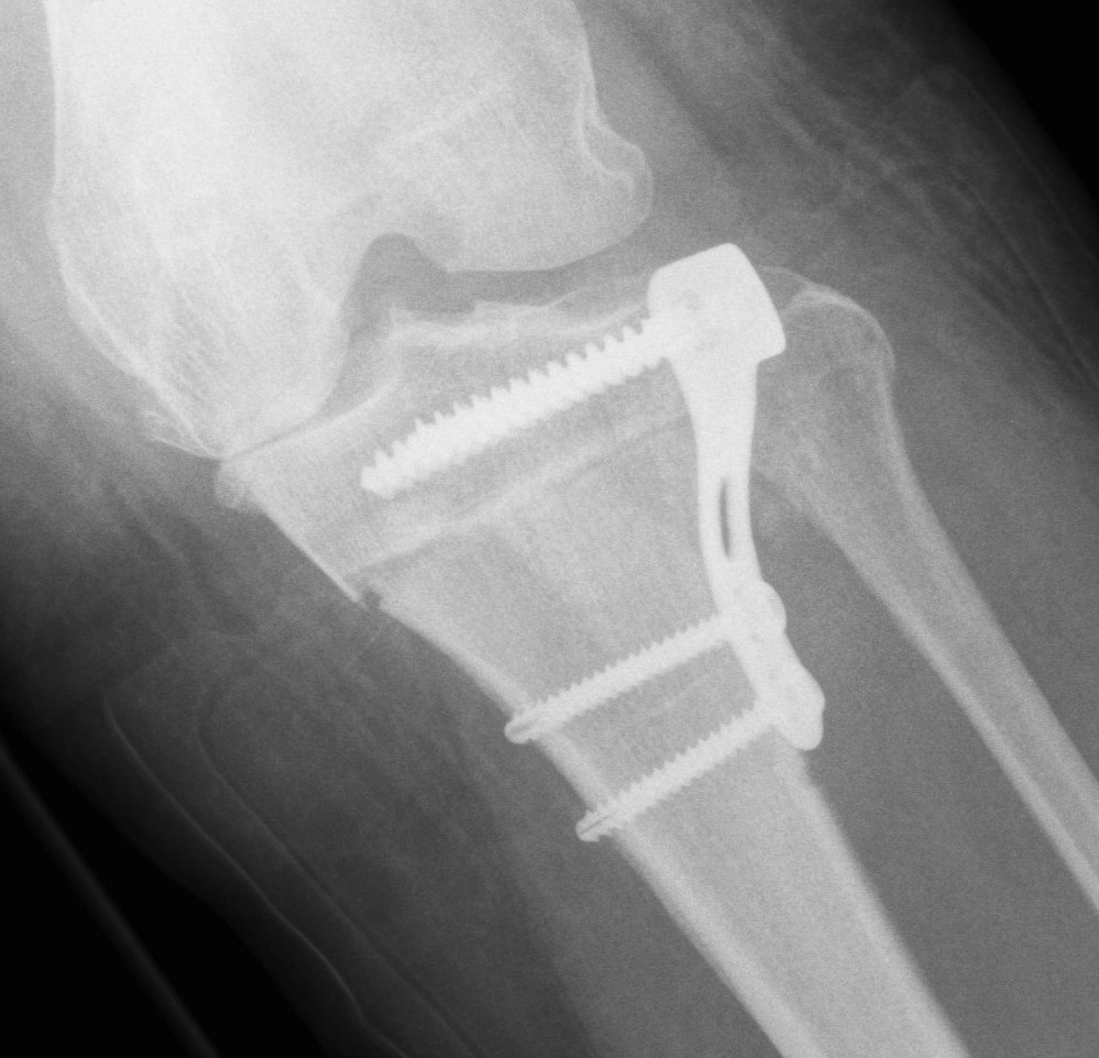 HInge fracture