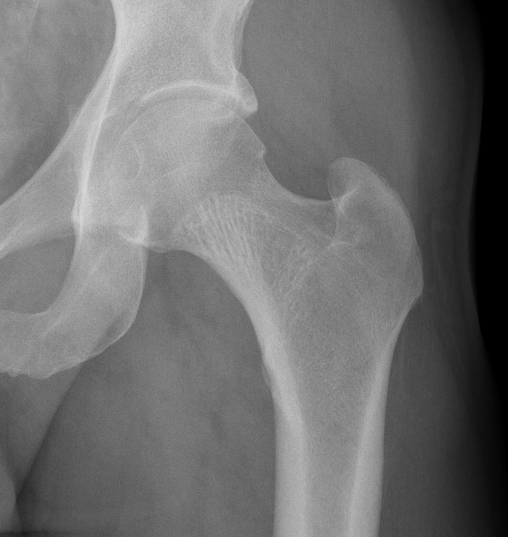 HIp hemangioma