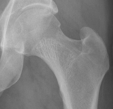 Hip hemangioma