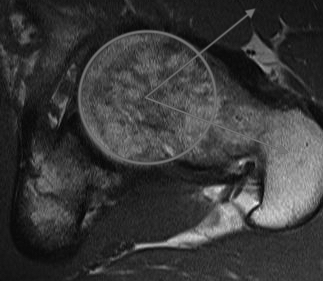 MRI anterior cam