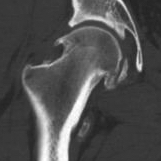 Femoral head osteophytes