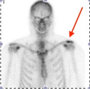 Hot ACJ Bone Scan