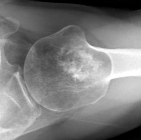 Humerus enchondroma 2