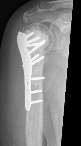 Prox humerus met 2