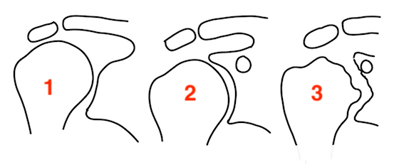 Levigne and Franceschi Classification Rheumatoid Shoulder