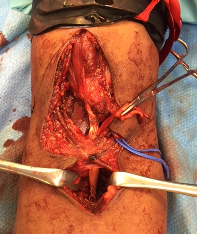 Single incision allograft reconstruction