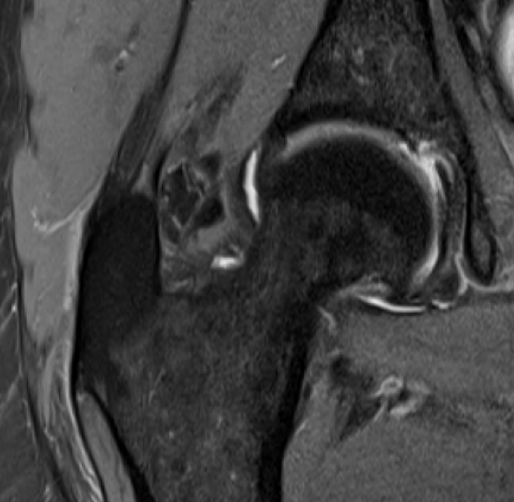 Intact gluteus medius MRI