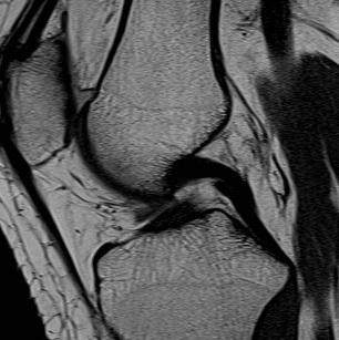 PCL MRI