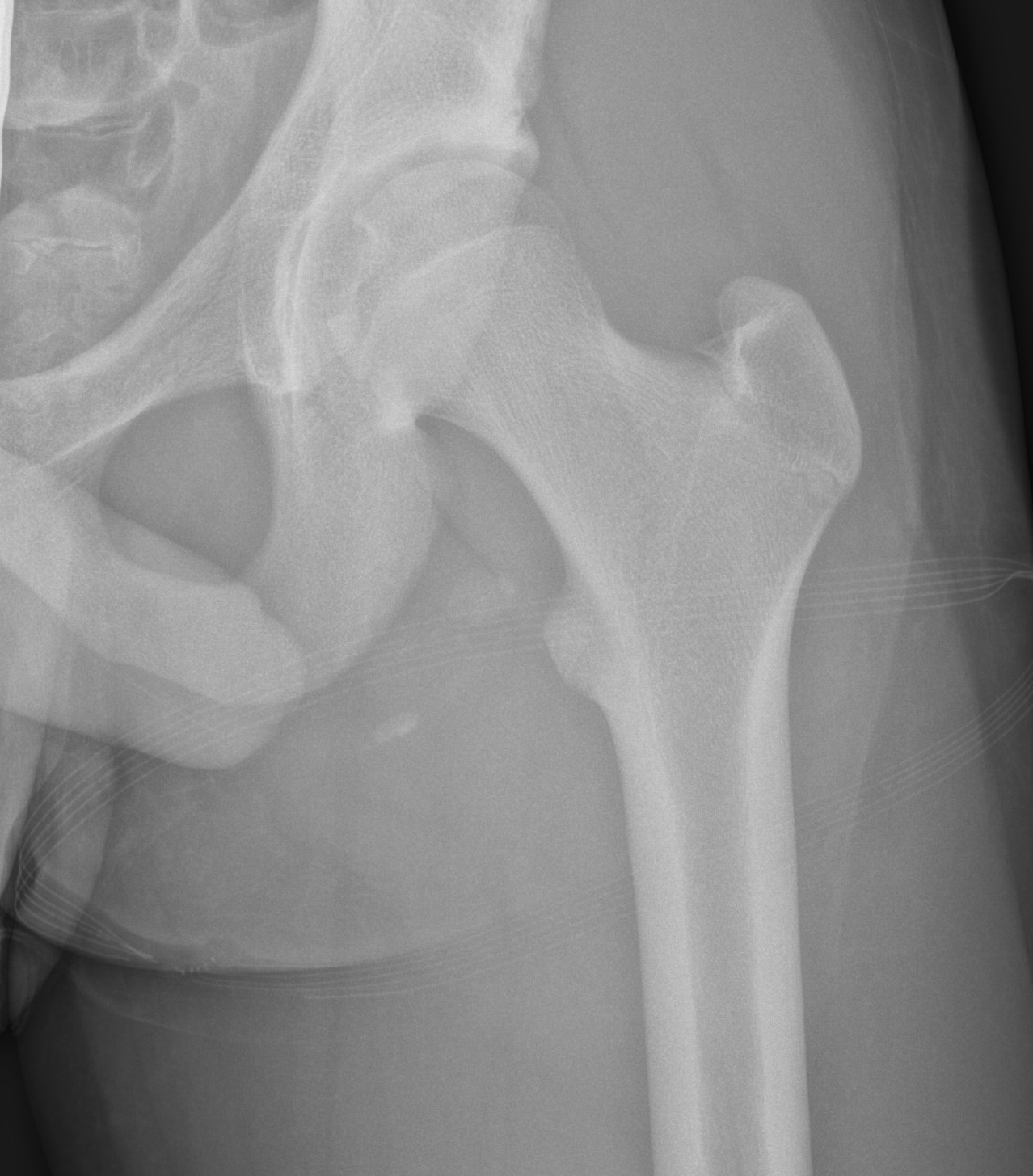 Ischial tuberosity avulsion 1