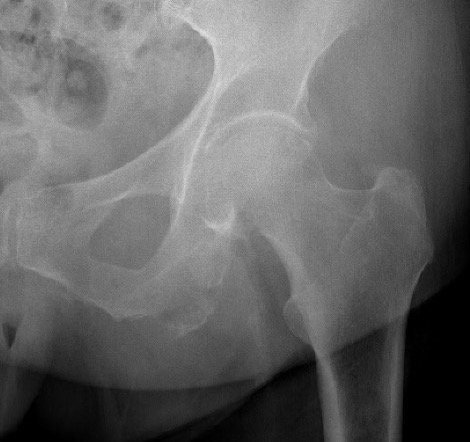 Ischial tuberosity avulsion 2