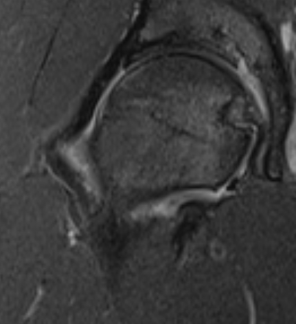 Bone marrow edema