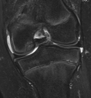 Stage 1 OCD MRI