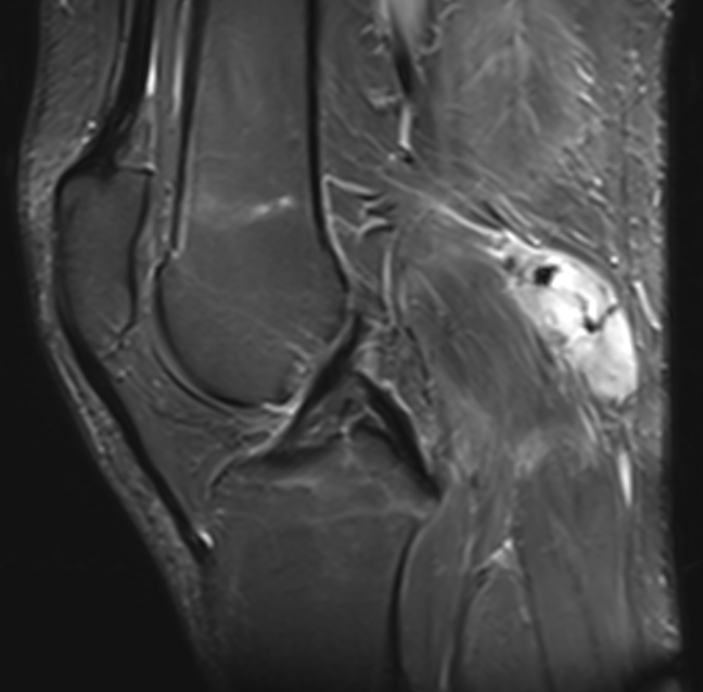 Knee sarcoma 1