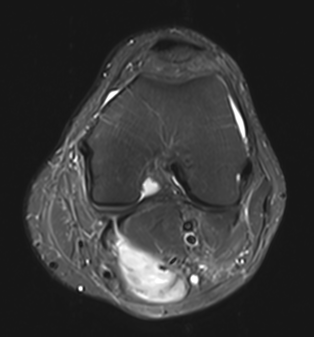 knee sarcoma 2