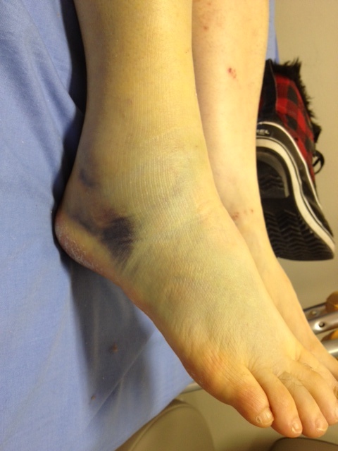 Lateral bruise